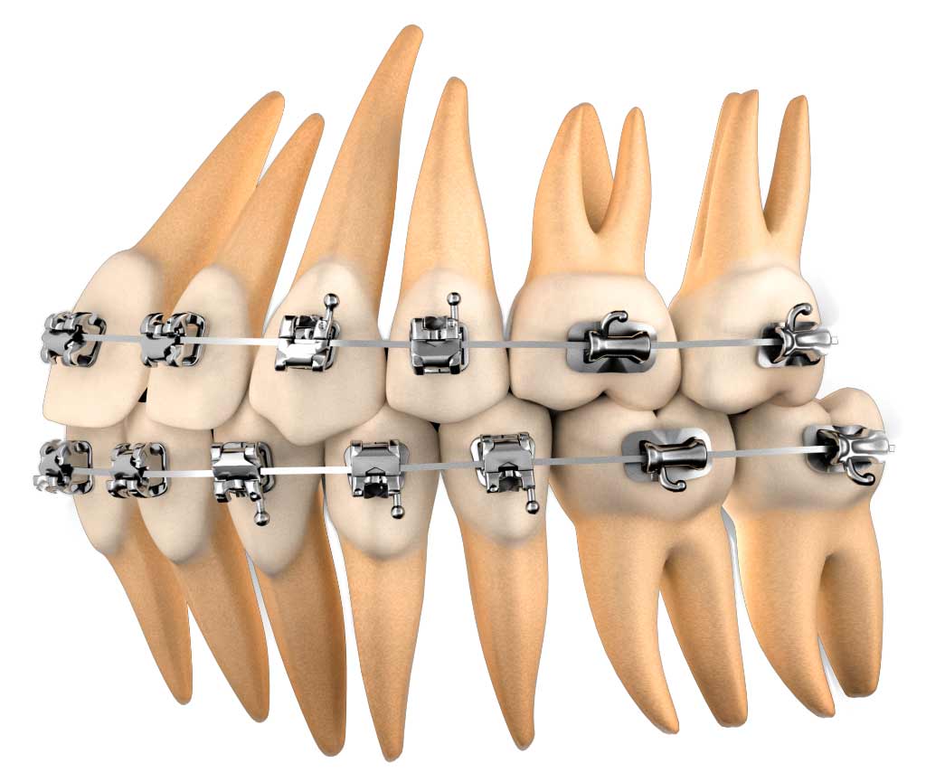 Brackets De Autoligado Ortodoncia At Elmer Holt Blog