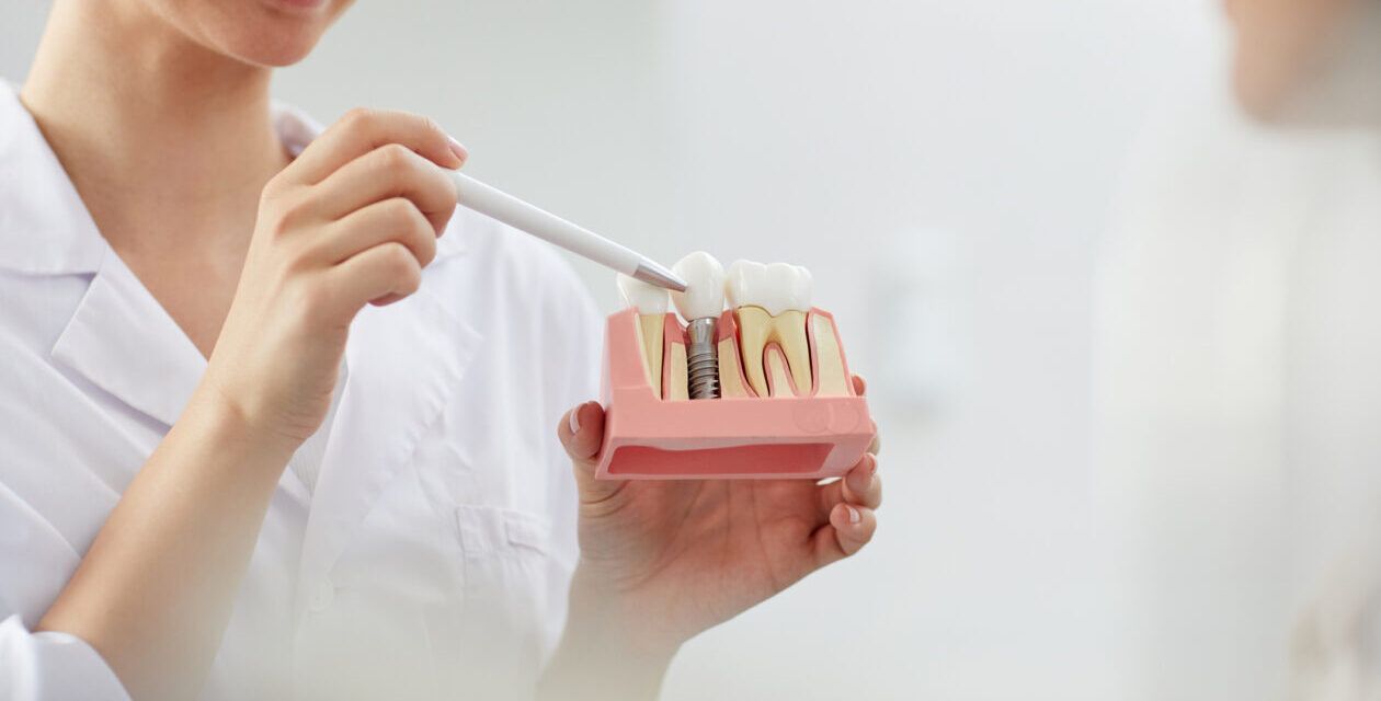 Implantes dentales – ¿Qué es un implante dental?