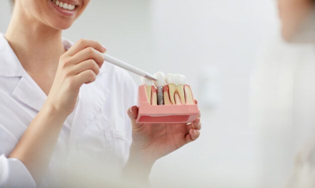 Implantes dentales – ¿Qué es un implante dental?
